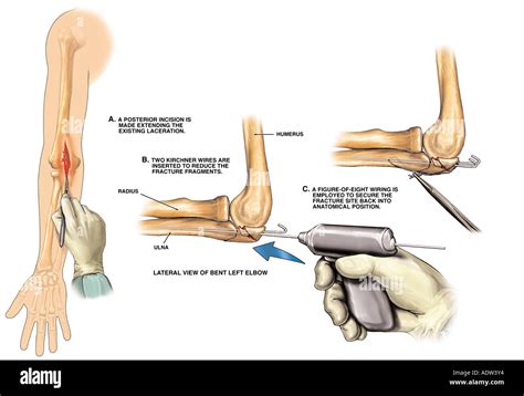 Fractured elbow hi-res stock photography and images - Alamy