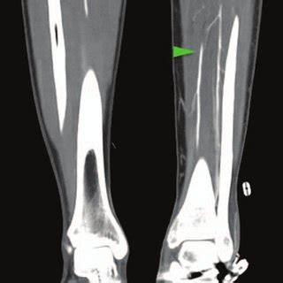 Computed tomography angiogram showing an extra anterior tibial artery... | Download Scientific ...