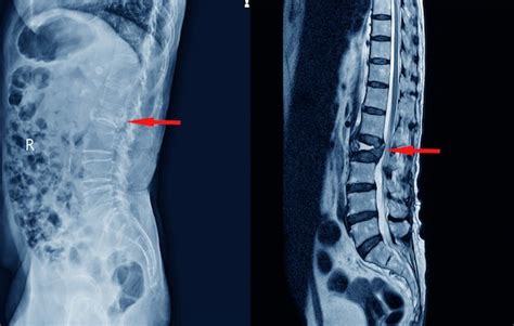 Premium Photo | Medical x-ray lumbar spine compression fracture on red arrow point