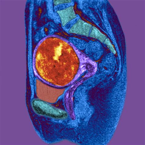 Fibroid Tumor Uterus