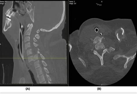 CT scan of C6-7 fracture dislocation (A) Cervical spine CT scan ...