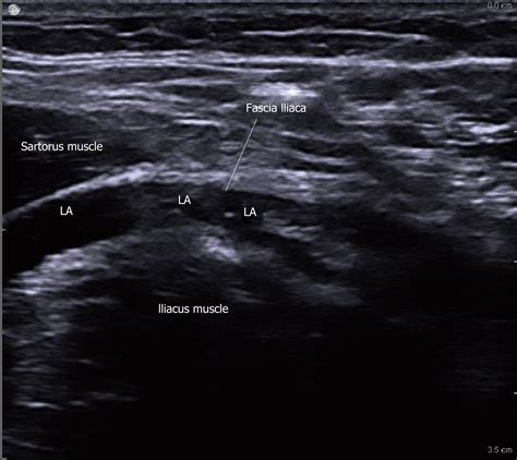 Fascia Iliaca Block Anatomy