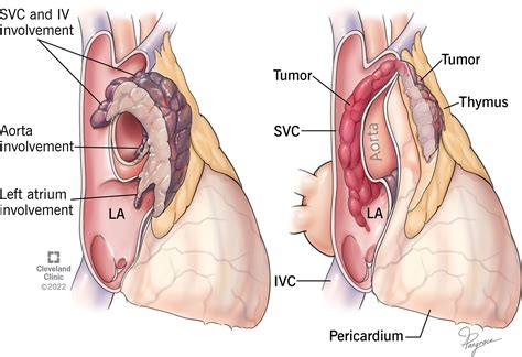 Frontiers | Thymomas With Intravascular and Intracardiac Growth