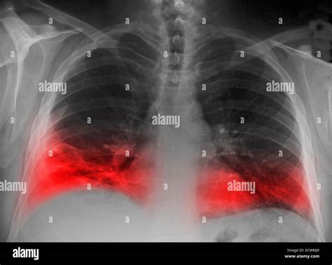 Chest x-ray showing a lung infiltrate of pneumonia Stock Photo ...