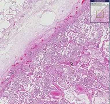 Histopathology Lung --Lobar pneumonia - YouTube