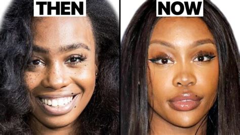 SZA Before Plastic Surgery - Surgical Tech