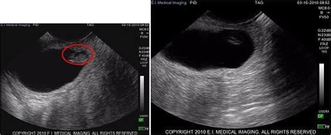 IBEX® Ultrasound: Stages of Early Bovine Pregnancy