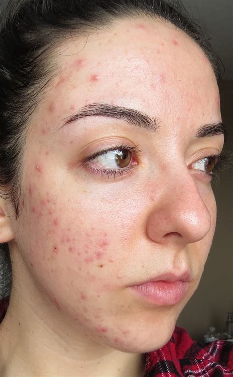 My Skin's Journey : Week 37: Banish Acne Scars