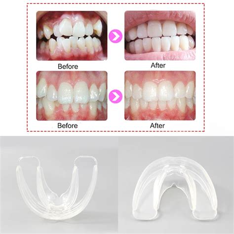 Orthodontic Braces Dental Braces Smile Teeth Alignment Trainer Teeth Retainer Mouth Guard Braces ...