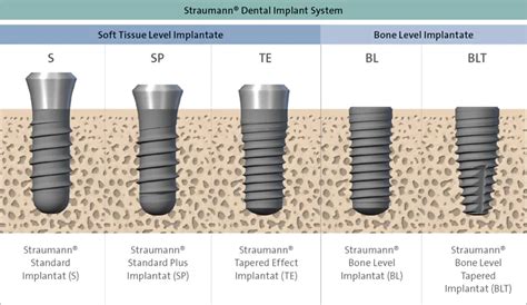 3Dcelo | L’enfouissement implantaire : Bone Level vs. Tissue Level