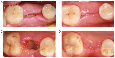 Clinical effect of platelet-rich fibrin on the preservation of the alveolar ridge following ...