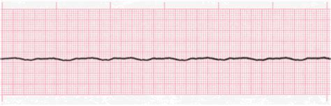 Asystole - EKG Lesson #315