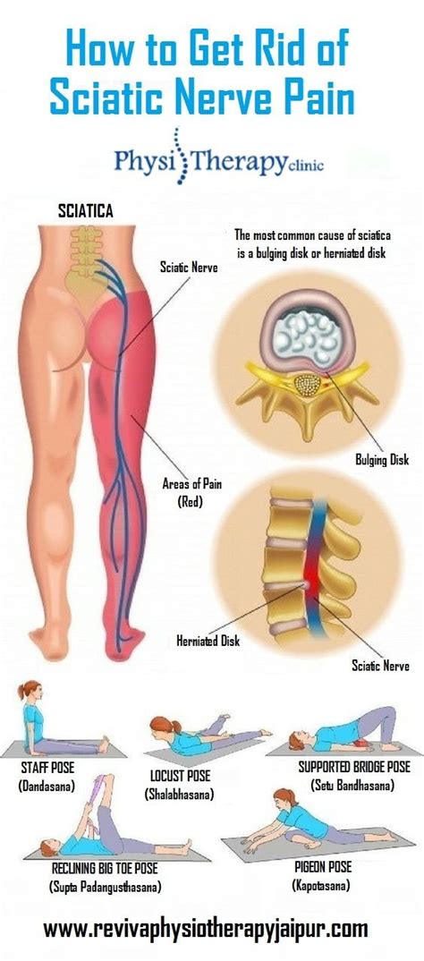 Pin on Sciatic Nerve Pain