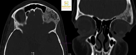 Fibrous Dysplasia | Radiology Case | - RadioGyan