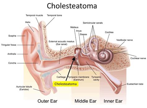 Cholesteatoma - Louis Hofmeyr | Ear infection remedy, Earache remedies, Ear infection home remedies