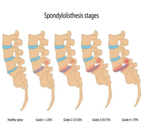 4 Non-Surgical Treatment for Spondylolisthesis | NJ Spine & Orthopedic