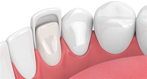 Composite Resin Bonding | Smile Works London