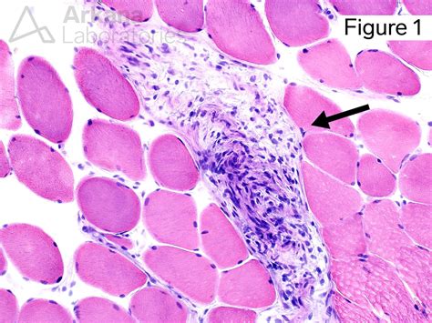 Neurofibromatosis Type 1 | Neuro Notes | Arkana Laboratories