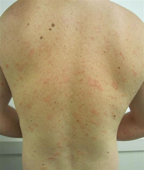 Pityriasis Rosea - Dermatology - Medbullets Step 1