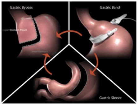 Lap Band Fail? Dr. Seun Sowemimo Specializes in Revision Bariatric Surgery — Prime Surgicare