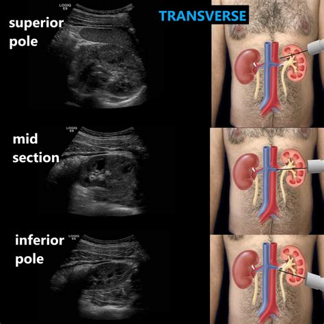 Renal Ultrasound Complete Protocol – Sonographic Tendencies