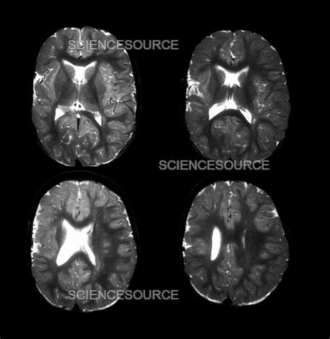 Photograph | MRI of Pachygyria | Science Source Images