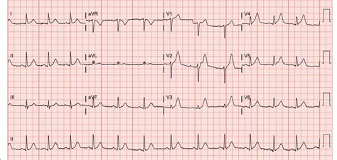 A Case Report: Acute Myocardial Infarction in a 29-year-old Male EMRA