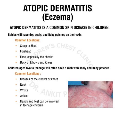 Atopic Dermatitis Vs Contact Dermatitis