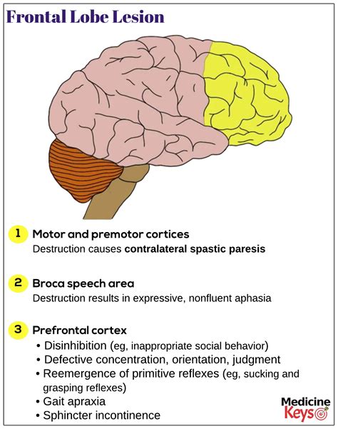 Frontal lobe lesions - Medicine Keys for MRCPs