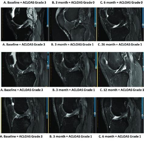 MRI images demonstrating MRI evidence of ACL healing for five ...