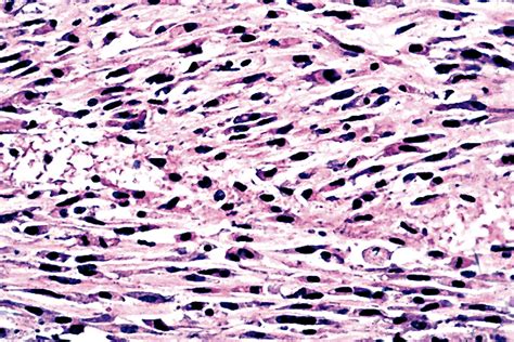 Pathology Outlines - Anaplastic carcinoma