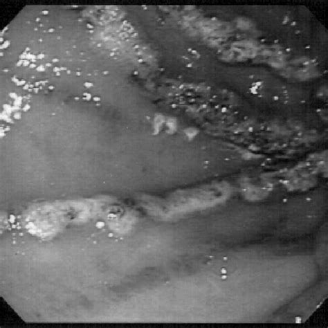 Watermelon stomach -antral region of the stomach with dilated vessels ...