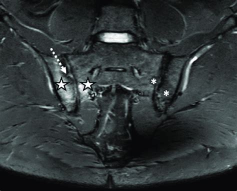 The MRI aspect of the sacroiliac joints included pseudo-widening of ...