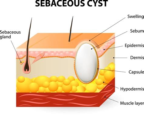 Cyst On Forehead Causes Symptoms Pictures Sebaceous Cyst White | SexiezPicz Web Porn