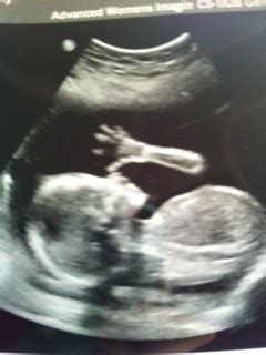 Mini Mall: Level II Ultrasound - 20 Weeks