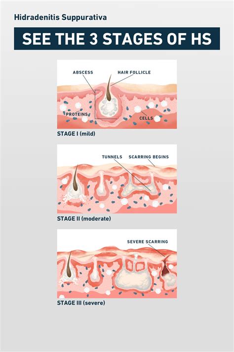 HS Symptoms & Pictures | No BS About HS