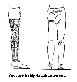 Hip-Disarticulation and Hemipelvectomy Prostheses - A Manual for Above ...