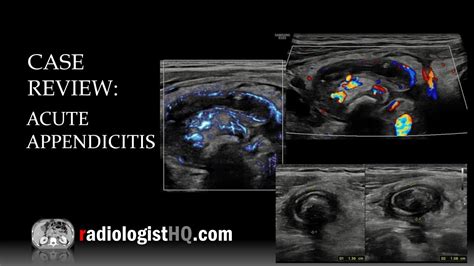 Ultrasound of Acute Appendicitis - YouTube