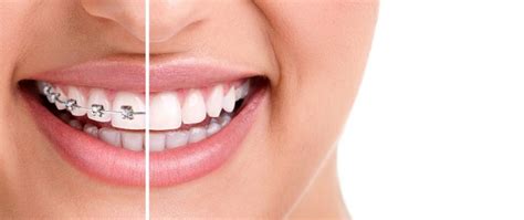 White Spots After Braces? Learn How Cosmetic Dentistry Can Help