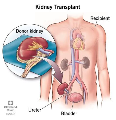 Kidney Transplant: Surgery, Purpose, Procedure & Recovery