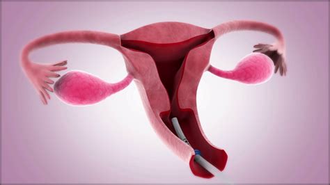 Insertion Of Intrauterine Device Into Uterus Stock Motion Graphics SBV ...