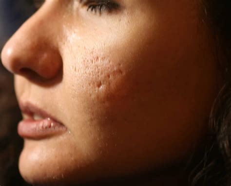 How to Get Rid of Acne Scars - HealthStatus