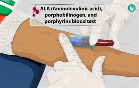 ALA (Aminolevulinic acid), porphobilinogen, and porphyrins blood test: Procedure, Purpose ...