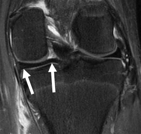 Monótono pollo Misterioso posterior horn medial meniscus tear mri inestable En marcha estafa