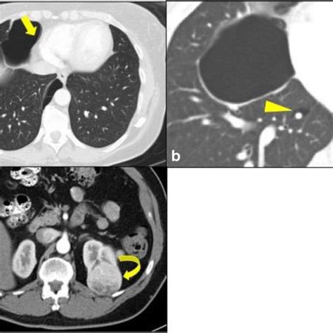 Birt-Hogg-Dube syndrome. a Axial noncontrast CT image of a patient with... | Download Scientific ...