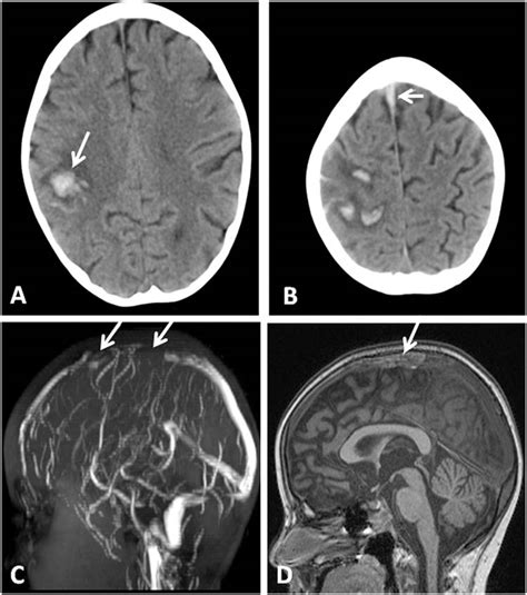 Cerebral Venous Sinus Thrombosis | Obgyn Key