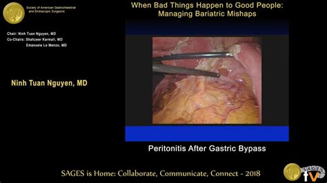 Laparoscopic Graham patch repair of a perforated marginal ulcer 6 yrs ...