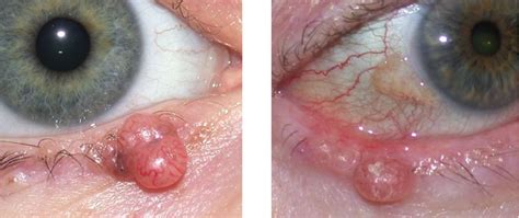 Eyelid Basal Cell Carcinoma - Warwar Eye Group