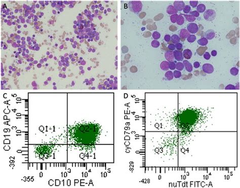 Full article: Successful treatment of acute lymphoblastic leukemia (ALL) during pregnancy using ...