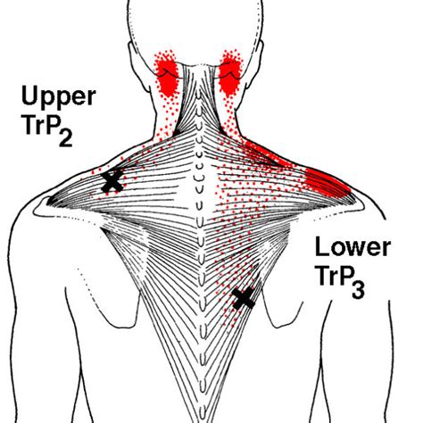 Referred pain patterns (red) from the upper and middle trapezius muscle... | Download Scientific ...